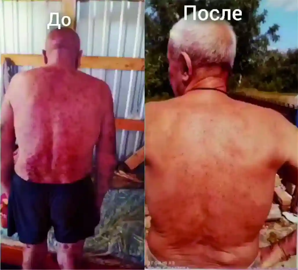 Результат лечения от псориаза