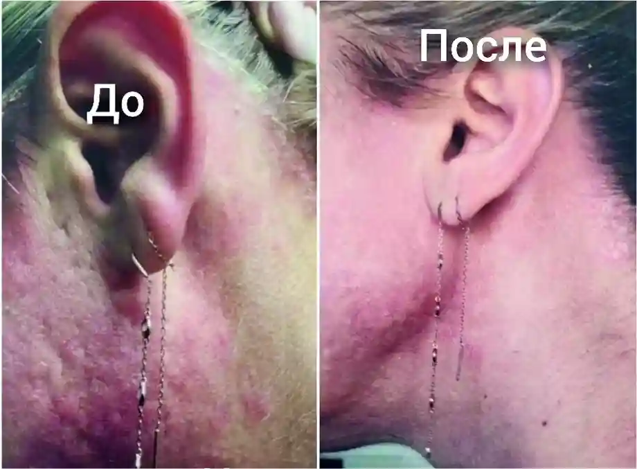 Результат лечения от псориаза