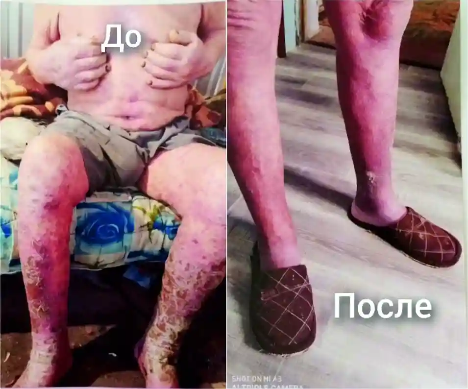 Результат лечения от псориаза