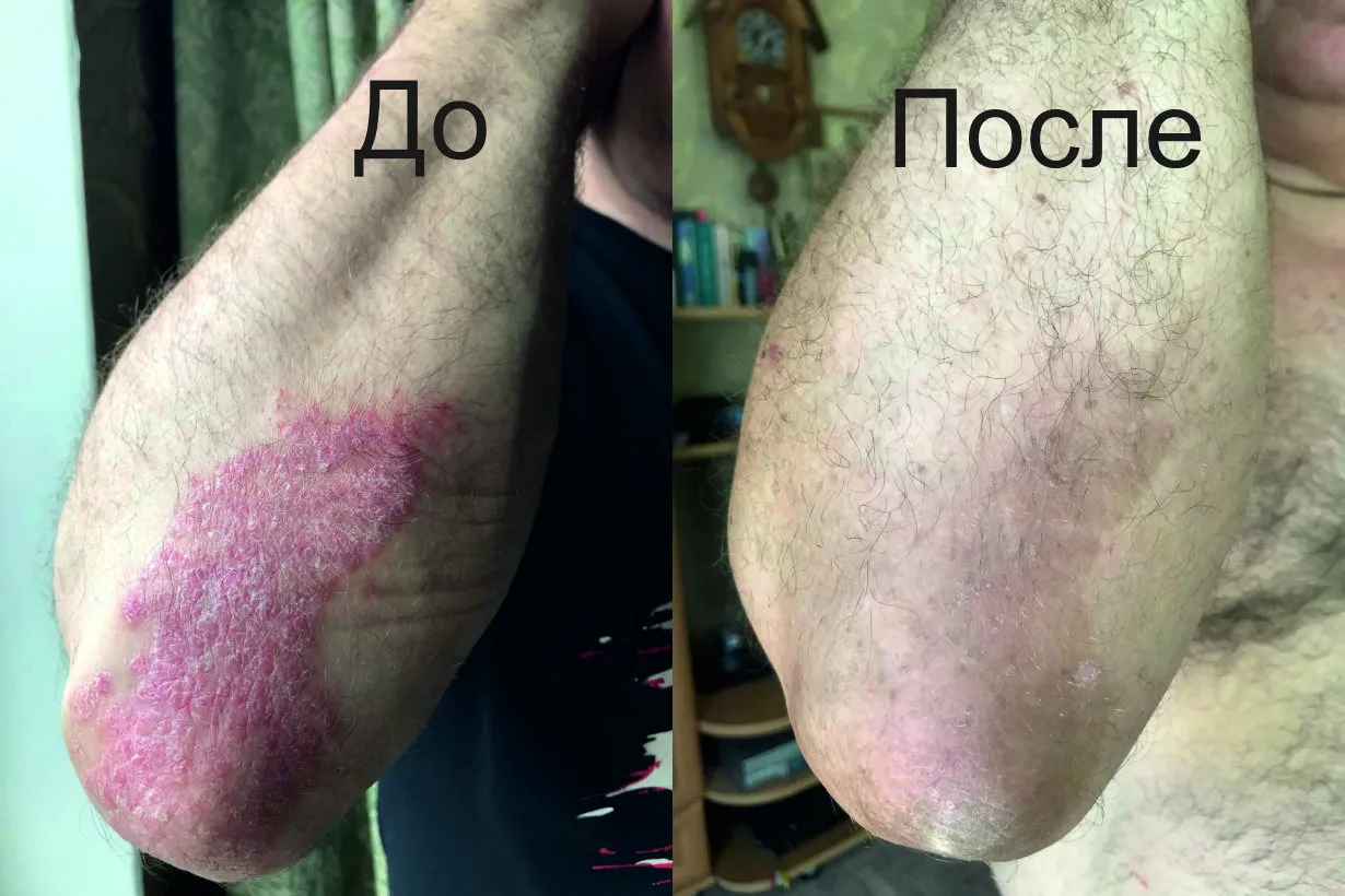 Результат лечения от псориаза