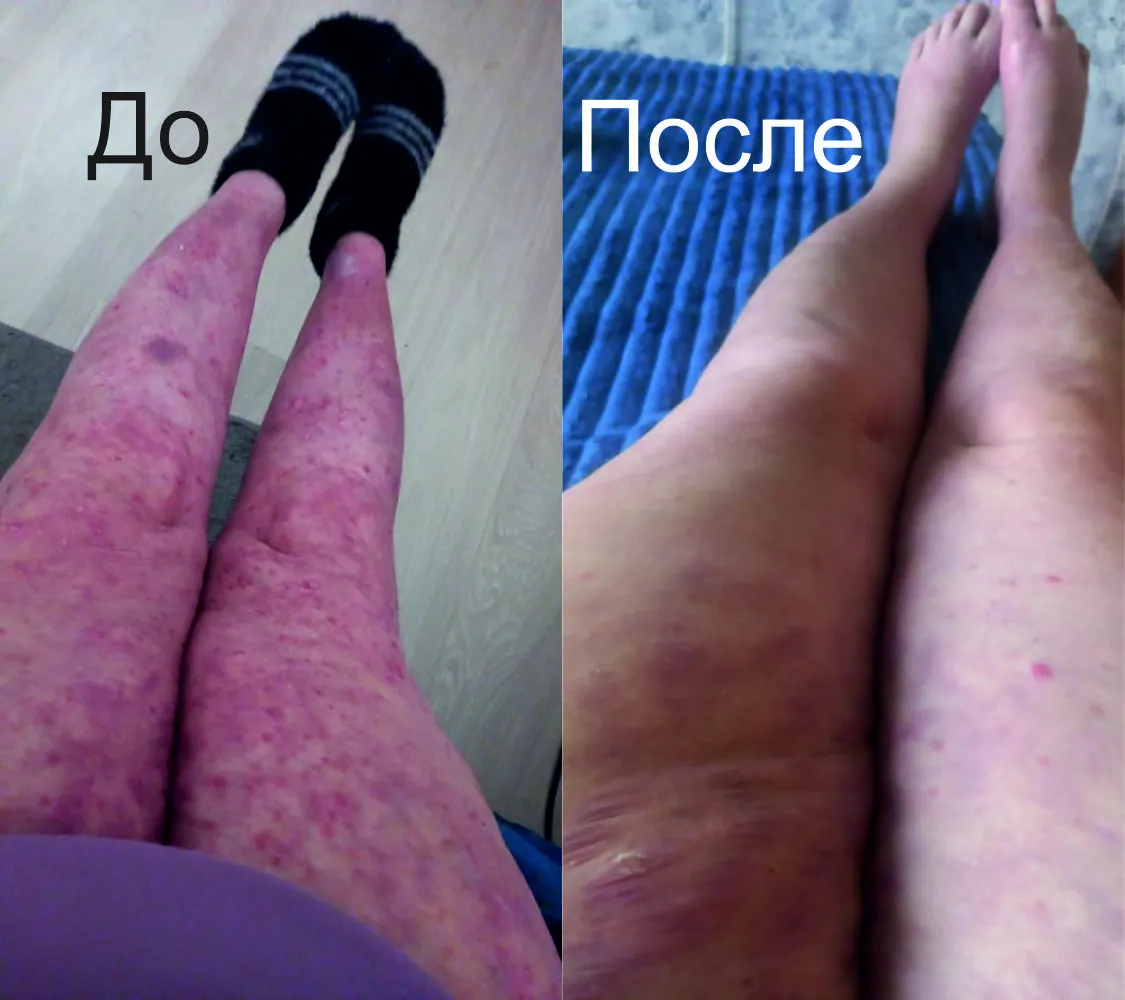 Результат лечения от псориаза