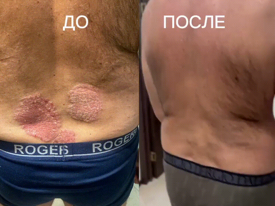 Результат лечения от псориаза
