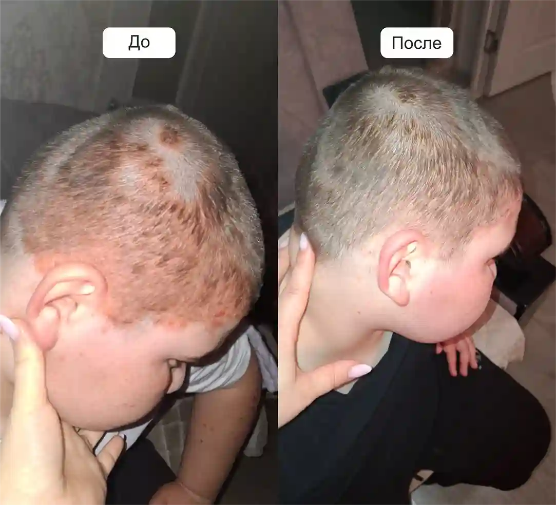 Результат лечения от псориаза