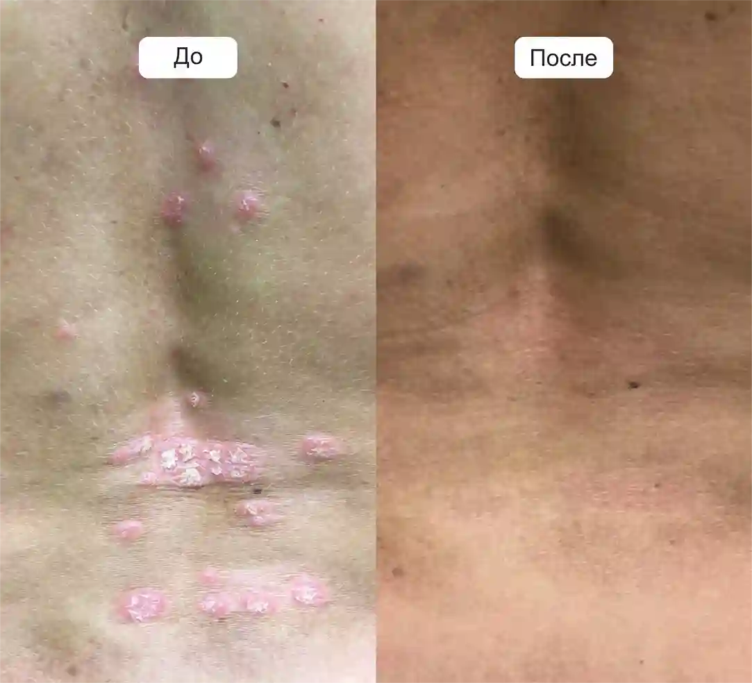 Результат лечения от псориаза
