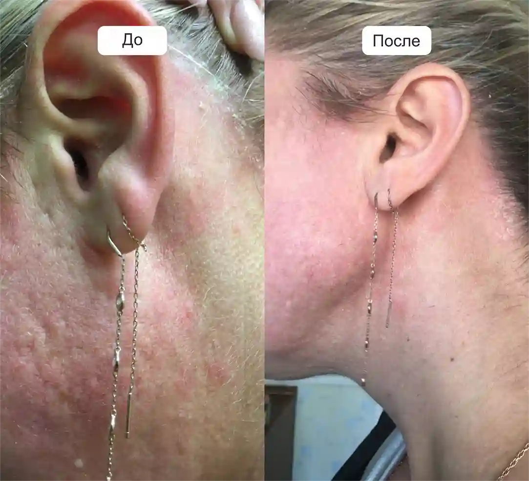 Результат лечения от псориаза